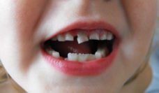 Closeup of a child's mouth with a loose tooth