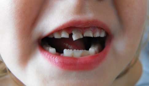 Closeup of a child's mouth with a loose tooth
