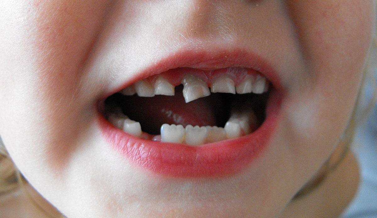 Closeup of a child's mouth with a loose tooth