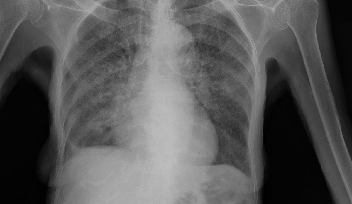 Xray of lungs with TB