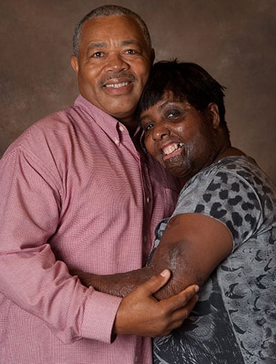 Man and a woman with a burn injury embracing