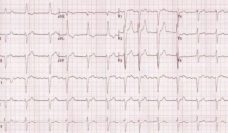 EKG showing atrial fibrillation