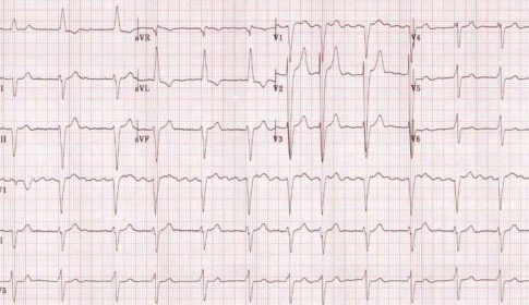 EKG showing atrial fibrillation